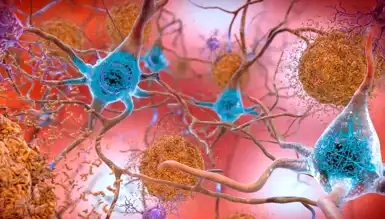 Alzheimer'da Kanser İlaçlarından Umut!